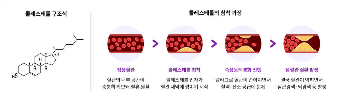 mgz_cholesterol_img2_pc.png 콜레스테롤 구조식과 콜레스테롤의 침착 과정