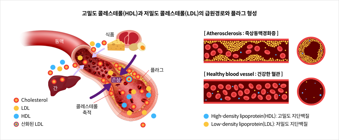 고밀도 콜레스테롤(HDL)과 저밀도 콜레스테롤(LDL)의 급원경로와 플라그 형성