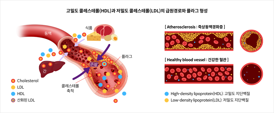 mgz_cholesterol_img3_pc.png 고밀도 콜레스테롤(HDL)과 저밀도 콜레스테롤(LDL)의 급원경로와 플라그 형성