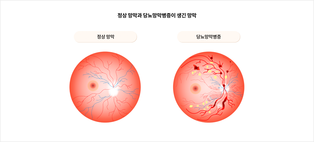 mgz_diabeticretinopathy_img2_pc.png 정상 망막과 당뇨망막병증이 생긴 망막