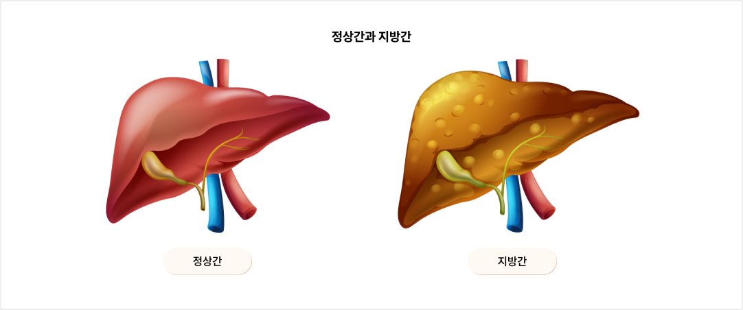 정상간과 지방간