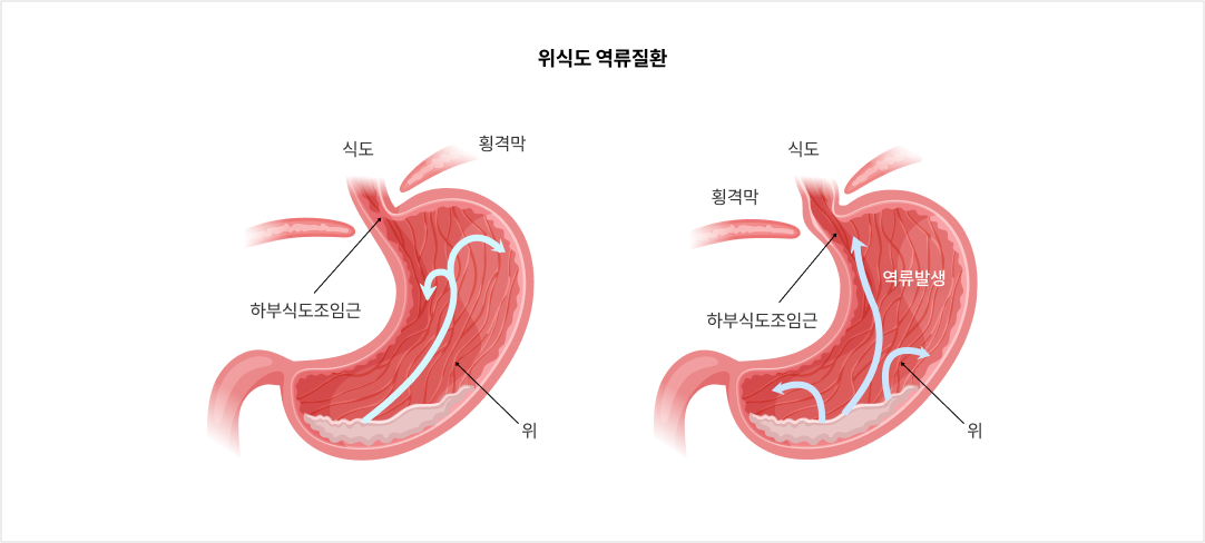 mgz_gerd_img2_pc.png 위식도 역류질환
