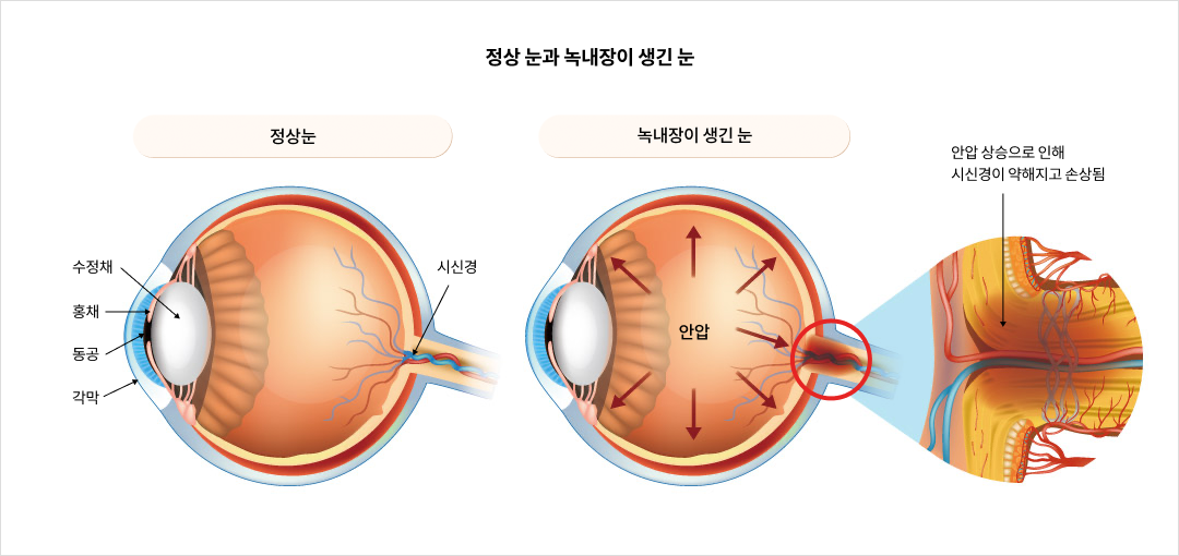mgz_glaucoma_img2_pc.png 정상 눈과 녹내장이 생긴 눈