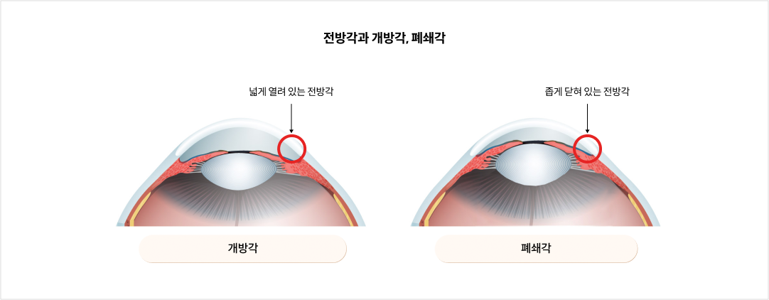 mgz_glaucoma_img3_pc.png 전방각과 개방각, 폐쇄각