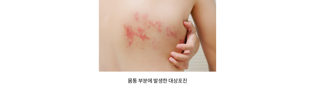 mgz_herpeszoster_img1_pc.png 몸통 부분에 발생한 대상포진