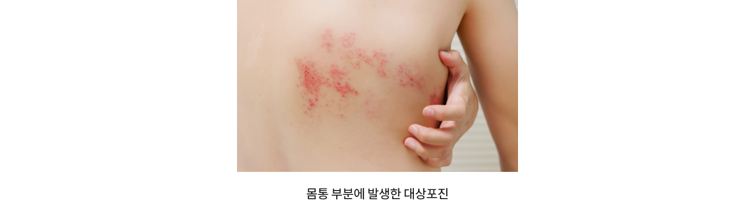 몸통 부분에 발생한 대상포진