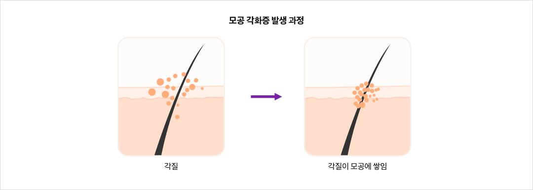 mgz_keratosis_img2_pc.png 모공 각화증 발생 과정