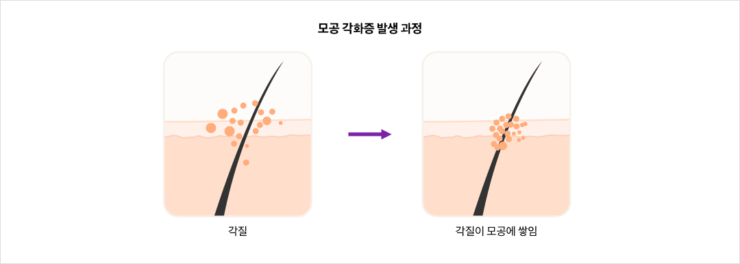 모공 각화증 발생 과정