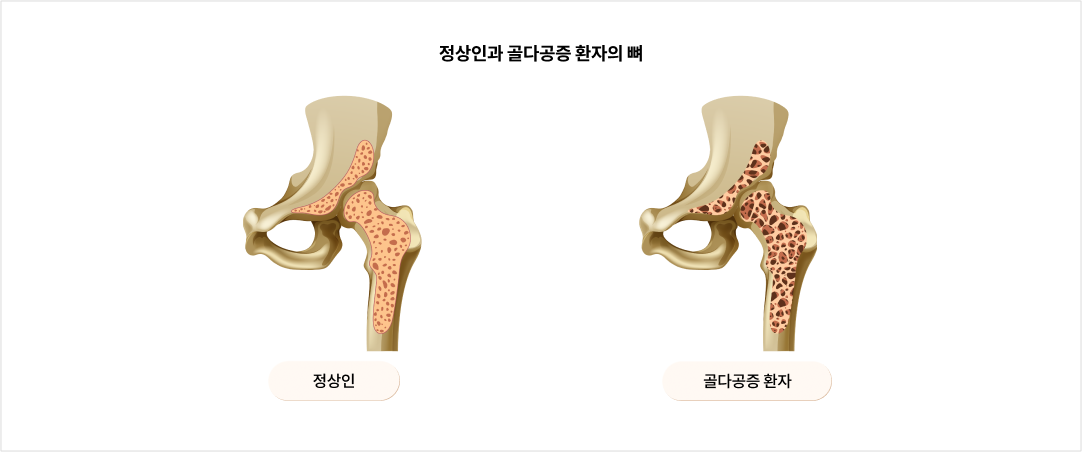 정상인과 골다공증 환자의 뼈