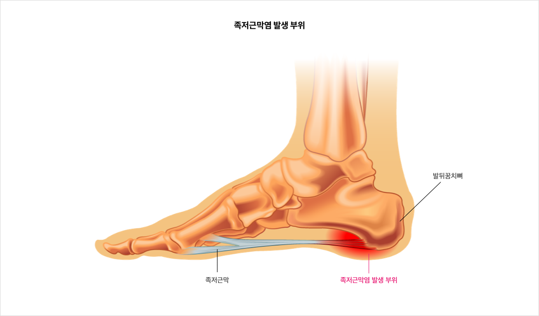 mgz_plantarfasciitis_img2_pc.png 족저근막염 발생 부위