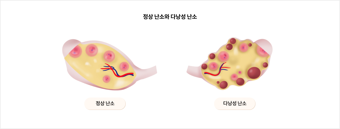 mgz_polycysticovariansyndrome_img2_pc.png 정상 난소와 다낭성 난소