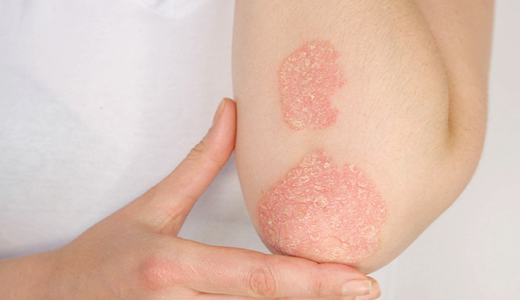 mgz_psoriasis_img1_pc.png 건선 이미지