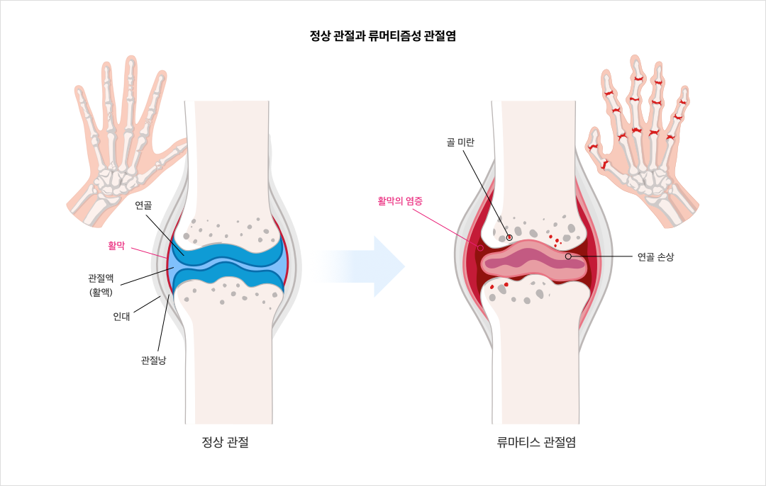 mgz_rheumatoidarthritis_img2_pc.png 정상 관절과 류머티즘성 관절염