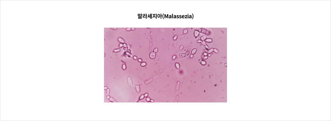 말라세지아(Malassezia