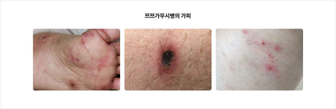 mgz_tsutsugamushi_img2_pc.png 쯔쯔가무시병의 가피