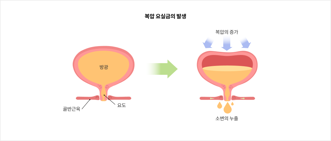 mgz_urinaryincontinence_img2_pc.png 복압 요실금의 발생